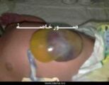 إجراء عملية نادرة وحرجة لطفل حديث الولادة بمستشفى عفيف